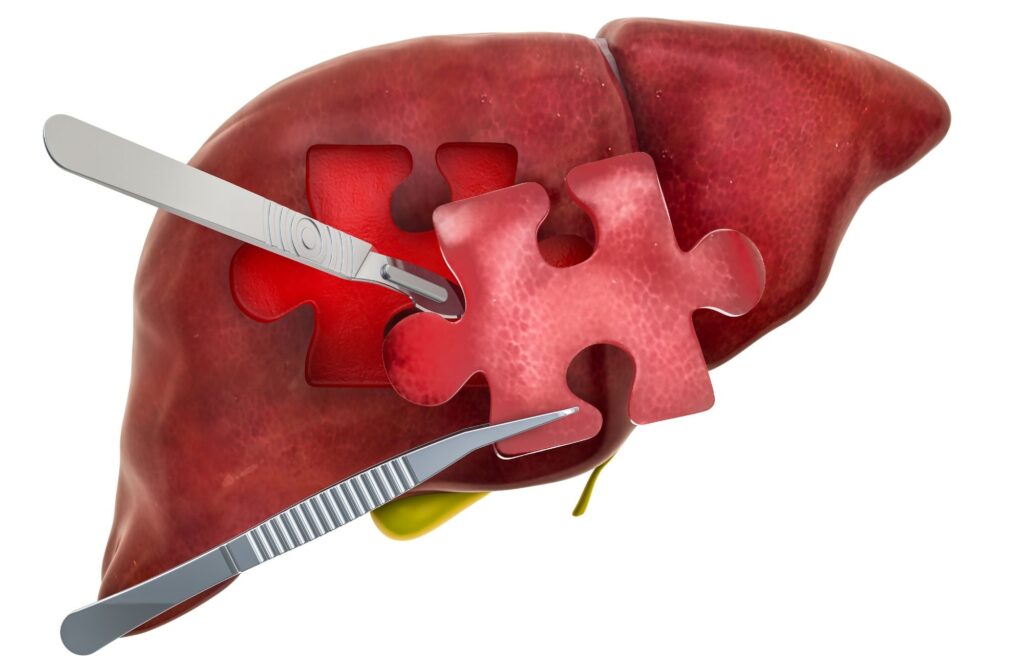 Fibrose hepática: o que é, sintomas e tratamento
