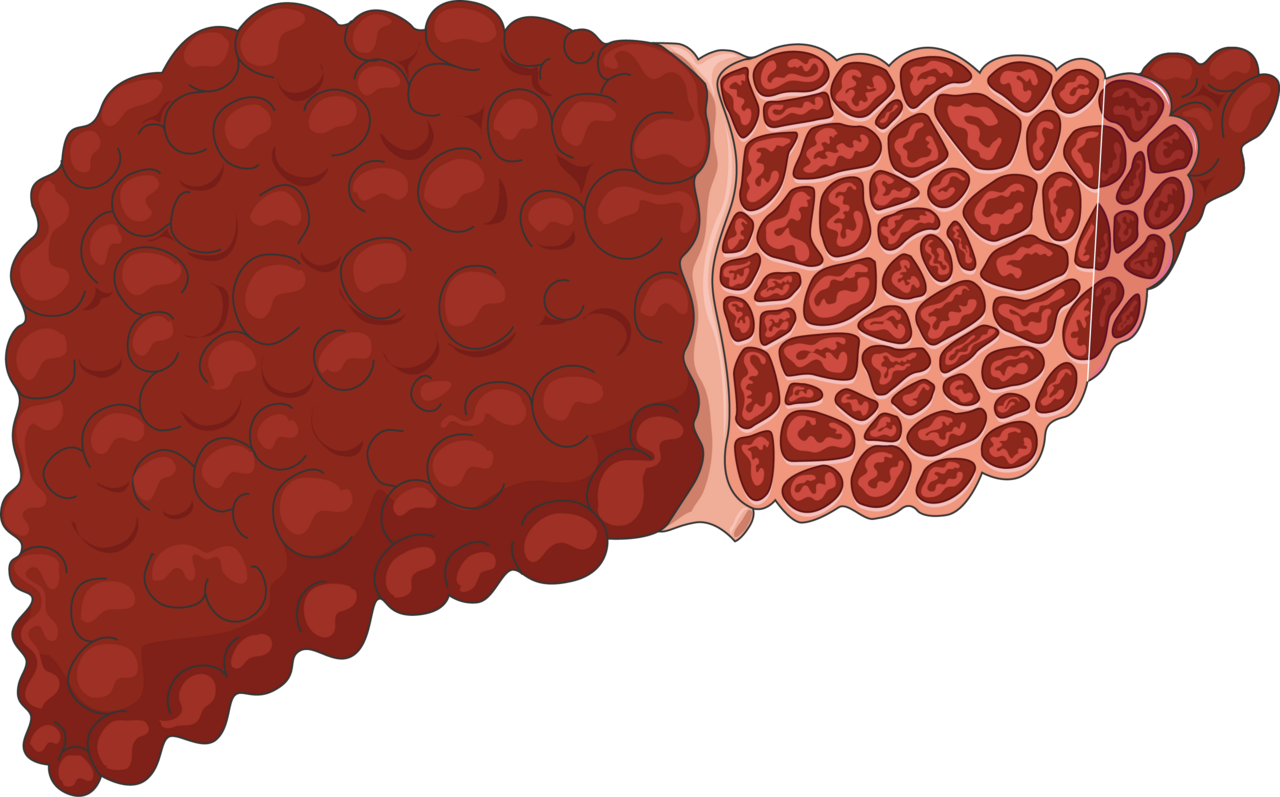 Fibrose hepática: o que é, sintomas, diagnóstico e tratamento